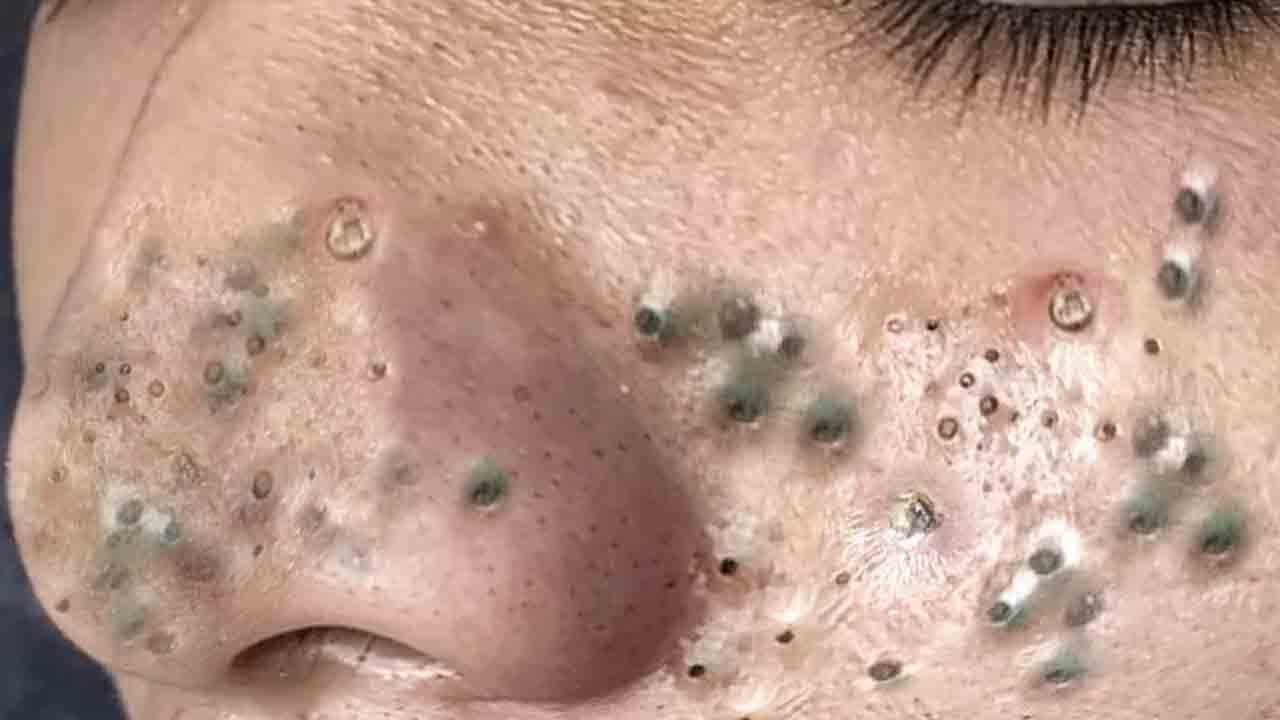 6 Ways to Get Rid of Pimples Fast