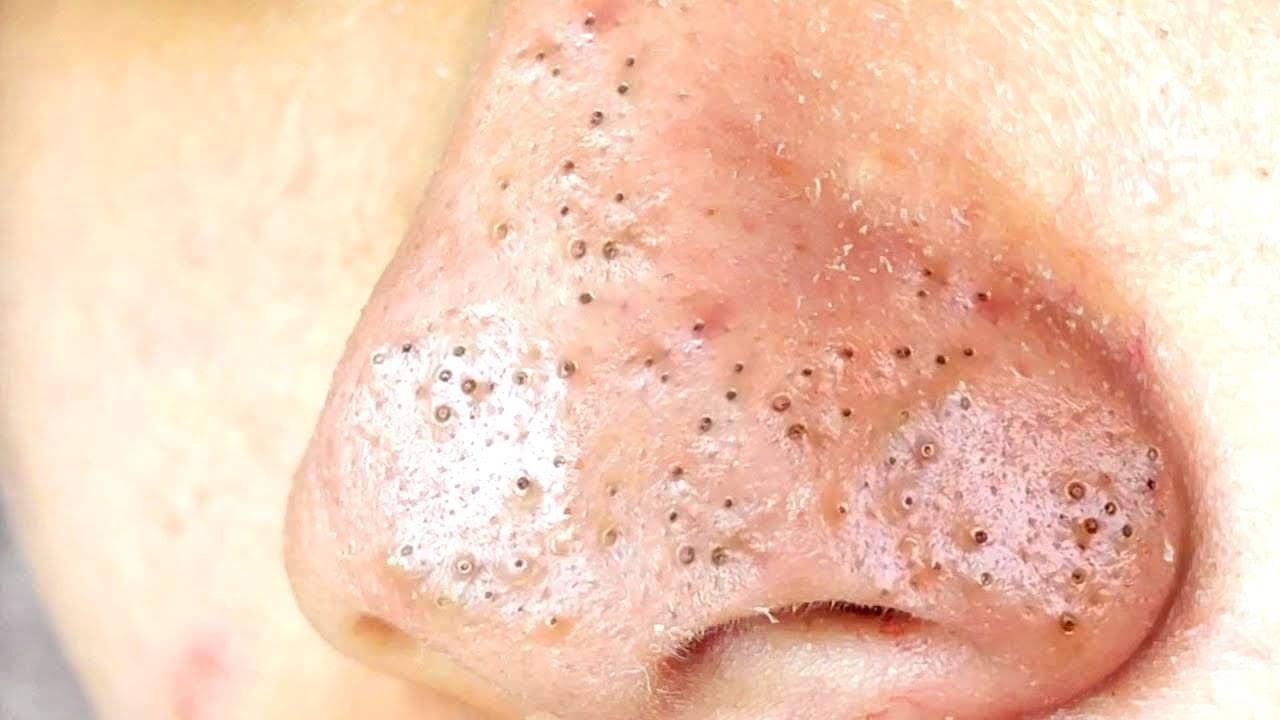 A Derm-Approved Acne Skin-Care Routine to Break Up With Your Breakouts