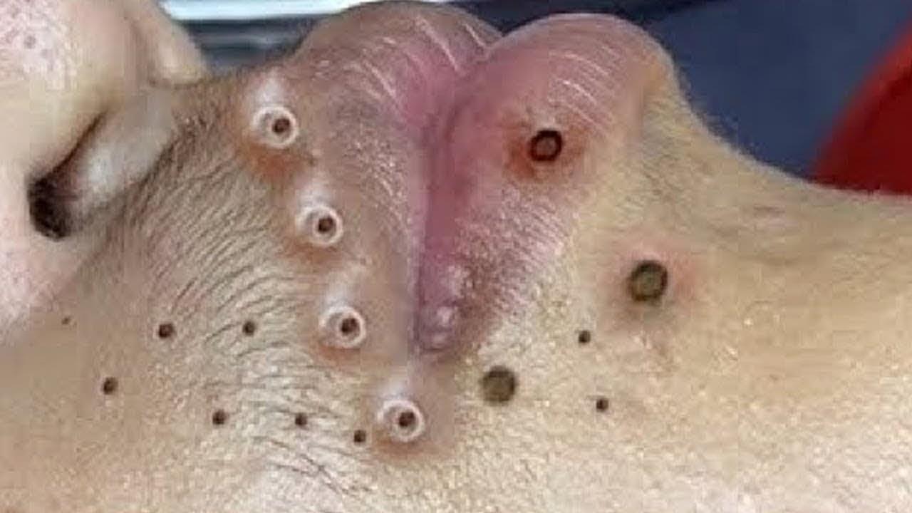 Acne before and afters
