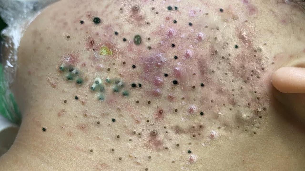 What to know about comedonal acne