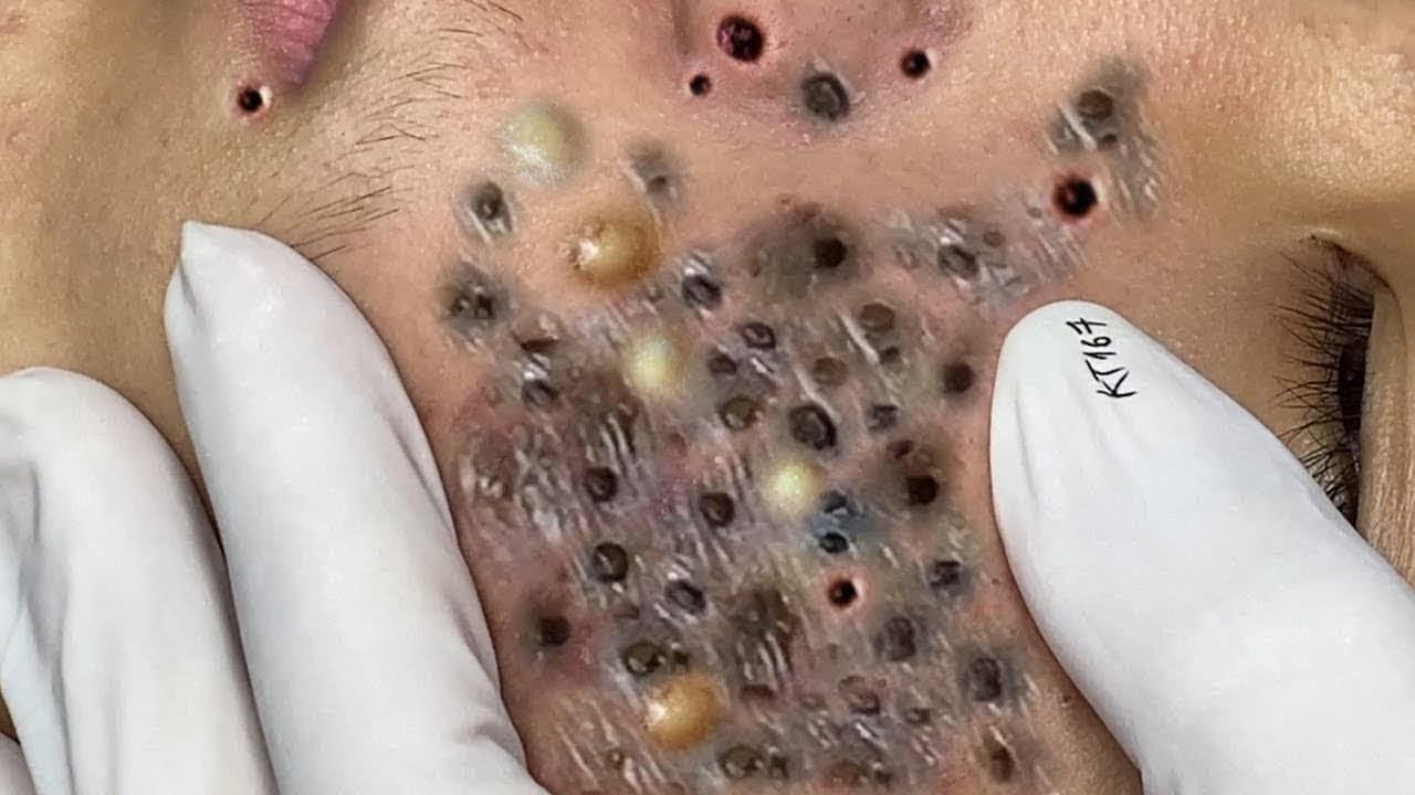 How do I get rid of blackheads safely?