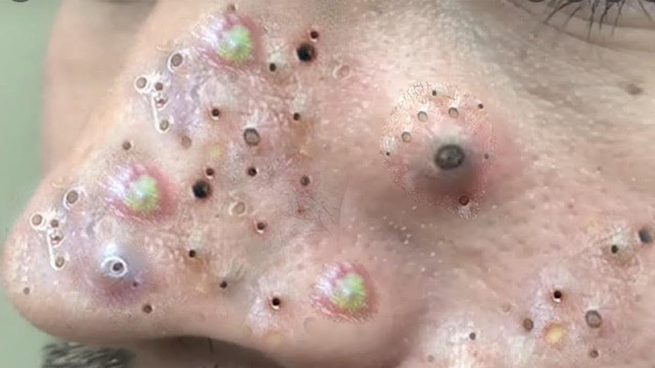 How do you prevent pimples?