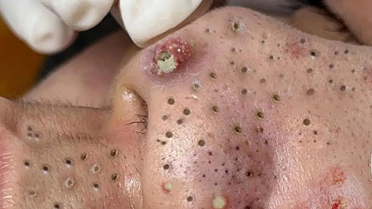 Behold: The Best Skincare Routine for Acne in 2024, According to Dermatologists