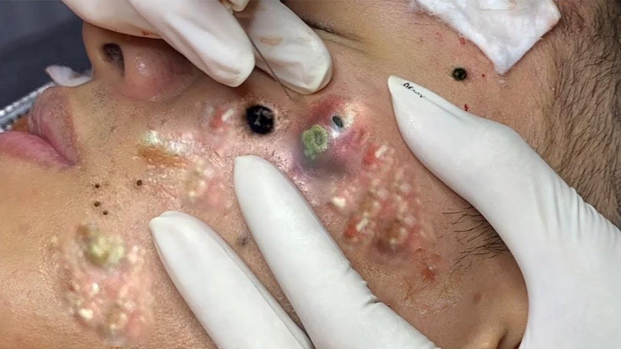 Acne & Blackheads: Symptom Identification, Scientific Prevention & Effective Treatment Guide